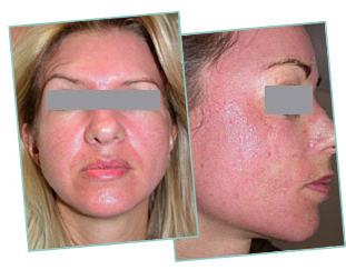 Dermaroller post treatment